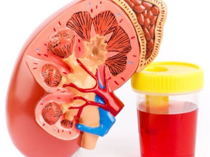 Blood in Urine (Hematuria) Treatment in Pune- Dr. Akhil S Mane at Leela Superspeciality Hospital