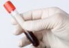 Is Blood in Urine Always Serious? When to Worry and When Not To