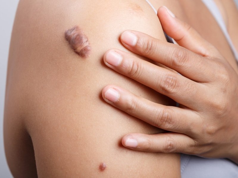 Best Keloid Treatment in Pune- Dr. Kiran Ardad-Mane