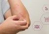 Skin Allergies: Symptoms, Triggers, and How to Avoid Them?