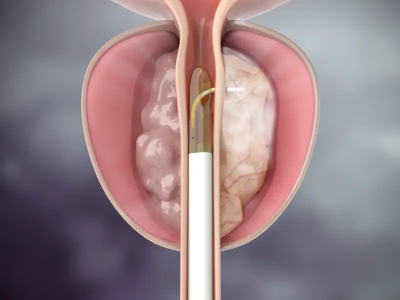 Rezūm Procedure in Pune- Dr. Akhil S Mane at Leela Superspeciality Hospital