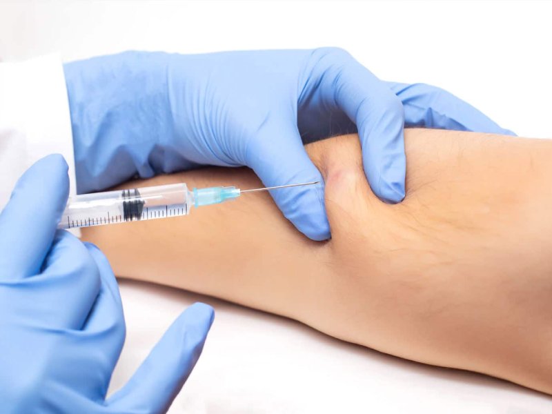 Skin Lipoma Treatment in Pune- Dr. Kiran Ardad-Mane