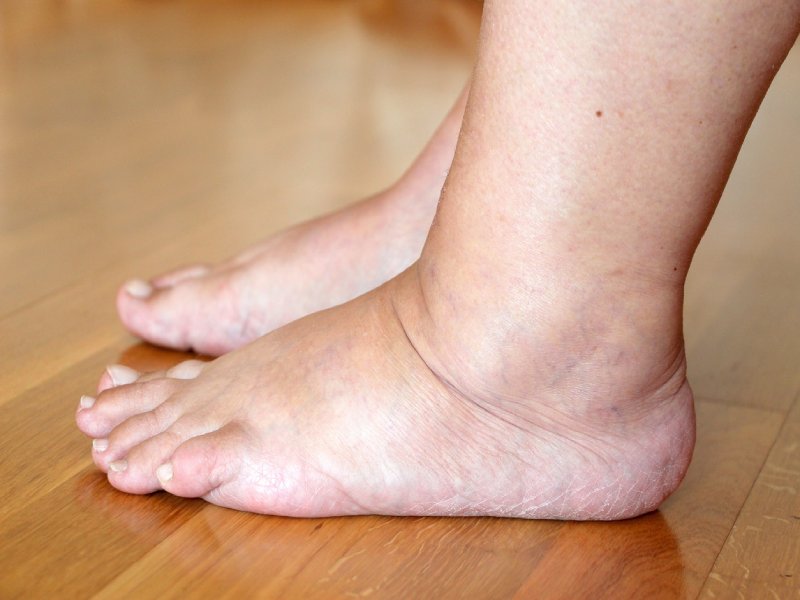 Leg and Ankle Swelling: Causes, Symptoms & Treatment | Dr. Sarang Barbind