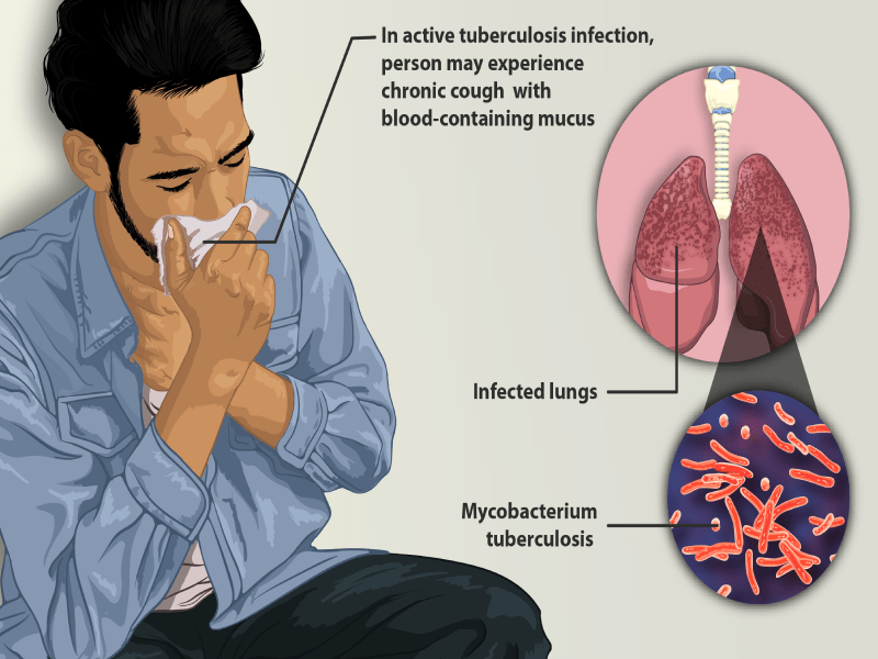 tuberculosis fever treatment | Dr. Sarang Barbind | Leela Superspeciality Hospital, Wakad
