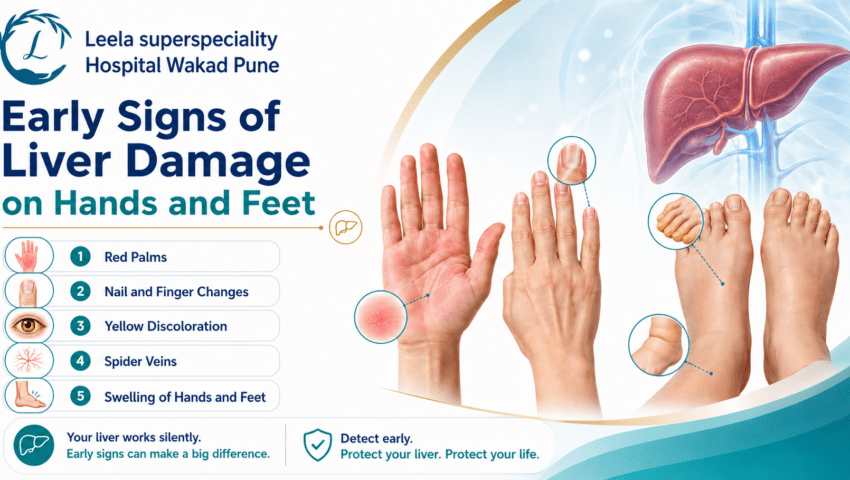 Infographic showing 5 early signs of liver damage on hands and feet — red palms, nail and finger changes, yellow discoloration, spider veins, and swelling — Leela Superspeciality Hospital, Wakad, Pune